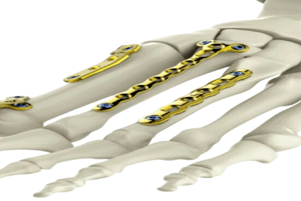 Mini Fragment Plating Manufacturers in Delhi