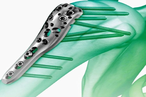 SMALL FRAGMENT - LOCKING PLATES Manufacturers in Delhi