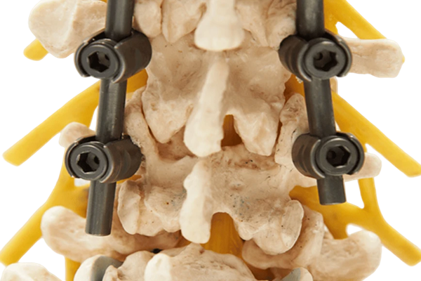 Spinal Implants Manufacturer in Delhi