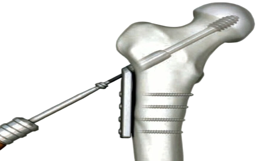 DHS/DCS Manufacturers in Delhi