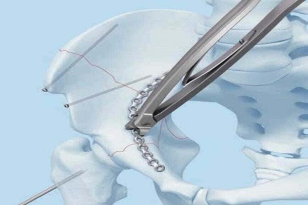 Small Fragment DCP Plates Manufacturers in Delhi