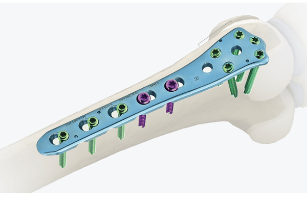 LARGE FRAGMENT LOCKING PLATE Manufacturers in Delhi